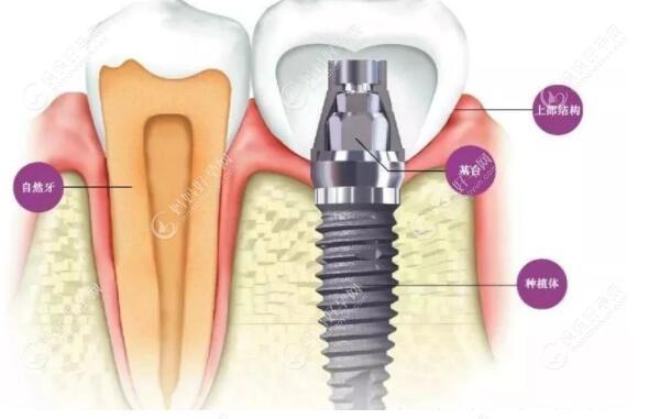 详解种植牙一期二期三期隔多久时间,以及一二三期手术时间