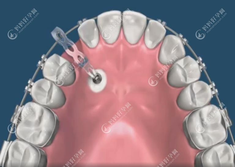 牙齿牵引一般用于埋伏牙牵引