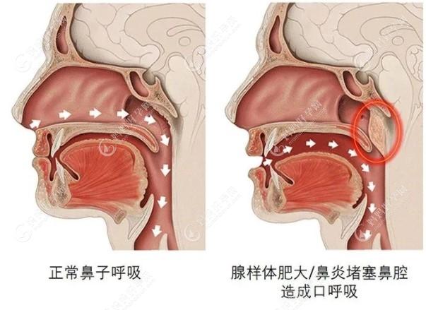 儿童口呼吸矫正器有必要用吗要根据口呼吸原因来判断