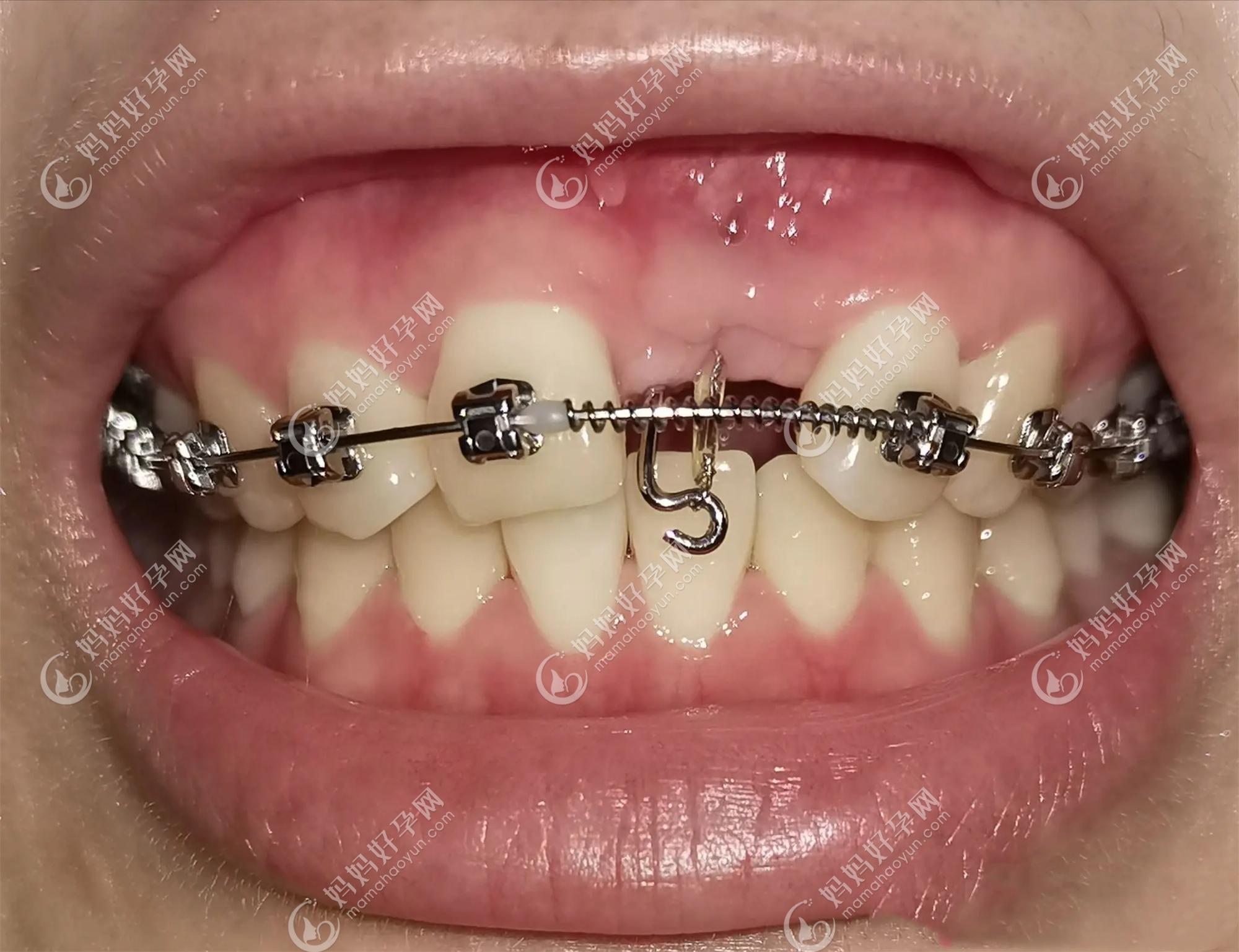 济南牙齿矫正案例丨【智齿牵引矫治】牙齿缺失不用种植系列 - 知乎