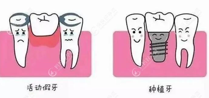 种植牙与活动假牙的区别