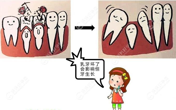 乳牙龋坏会影响恒牙生长