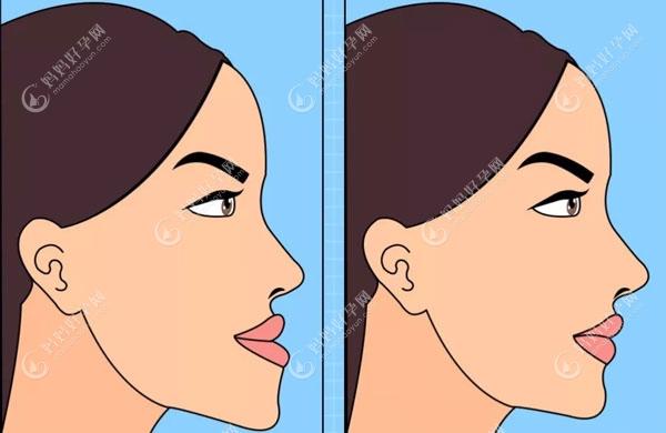 反颌矫治的侧面脸型变化图