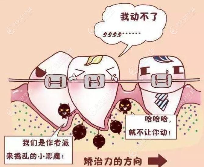 孩子做牙齿矫正拔牙危害是什么