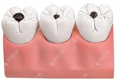 牙冠修复多用于大面积缺损的修复