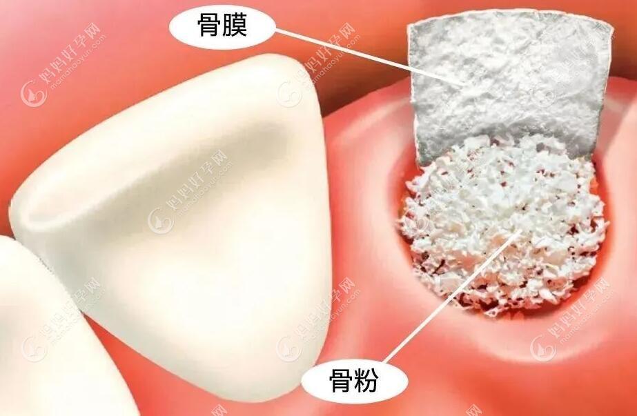 部分种植手术所需的植骨