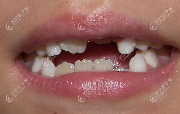 儿子8岁2颗门牙间缝隙比较大,问:孩子换的门牙中间有缝咋办