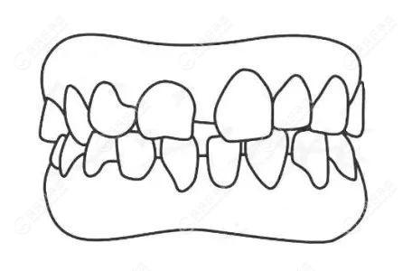 乳牙整齐换牙后变歪是提前干预好,还是等到牙全换完再矫正