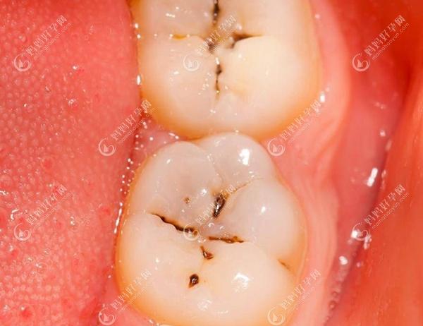 儿童牙齿龋齿补救方法