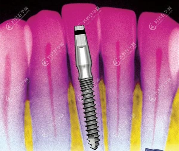 适合窄小牙槽嵴的细直径植体