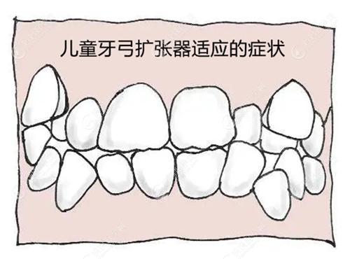 儿童牙弓扩张器适应的牙齿症状