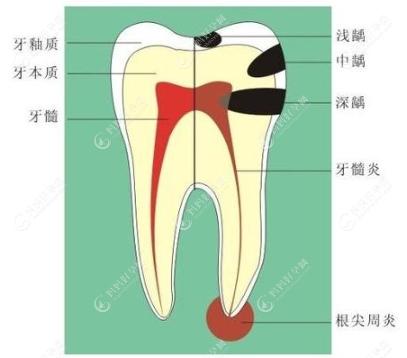 乳牙牙髓炎需要进行根管治疗吗