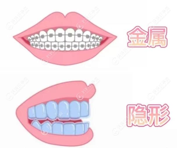 隐形牙套和固定牙套的价格区别