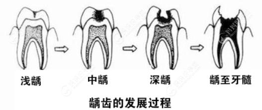 乳牙牙髓炎的发展过程