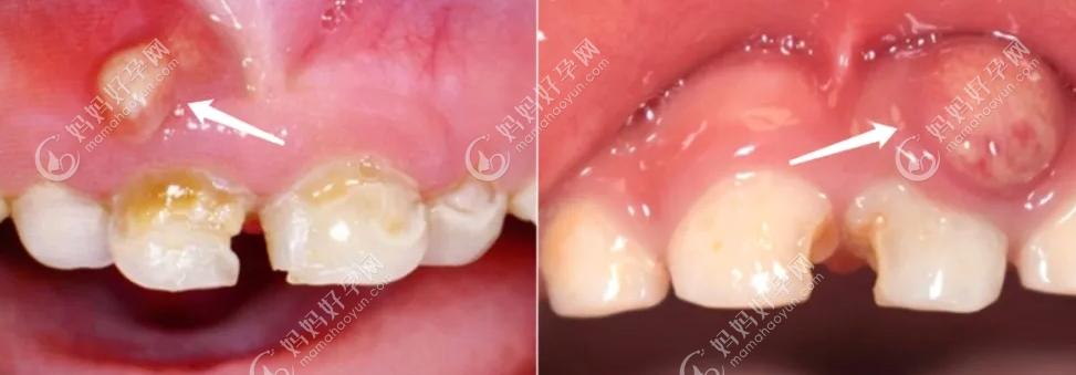 儿童牙齿常见的6大疾病蛀牙牙髓炎根尖囊肿的解决方案是