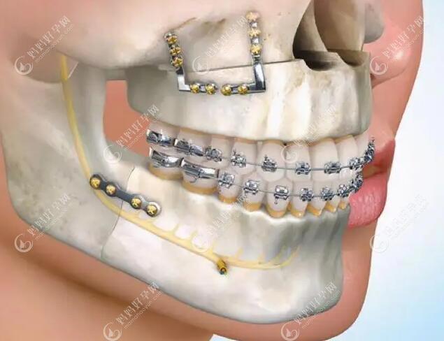 重度骨性龅牙做正颚手术要多少钱?据说正畸联合正颚在12万+