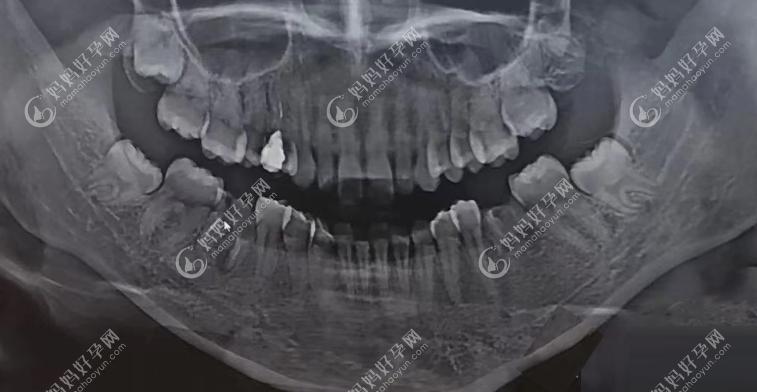 6岁孩子大牙烂的只剩牙根了适合拔的情况