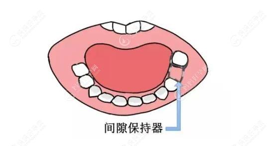 儿童牙齿间隙器