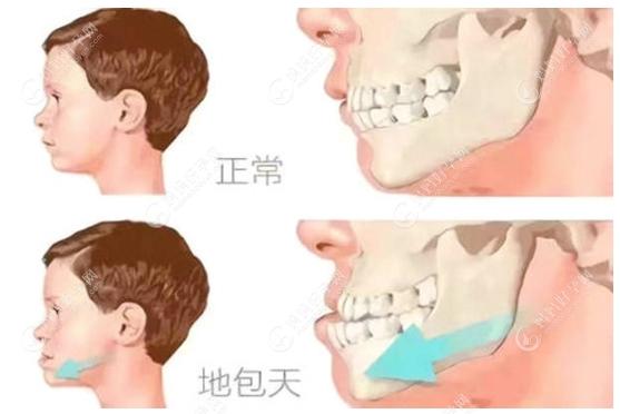 地包天和正常牙齿的区别对比