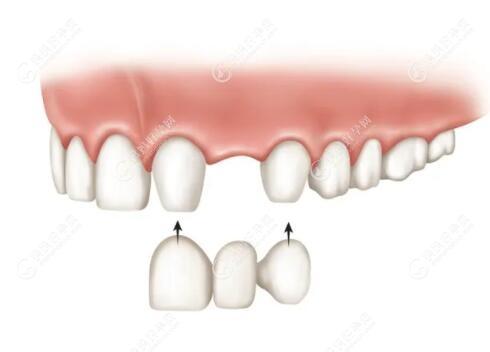 后槽牙连着缺失2/3颗怎么安装假牙?多颗连掉还能镶固义齿吗
