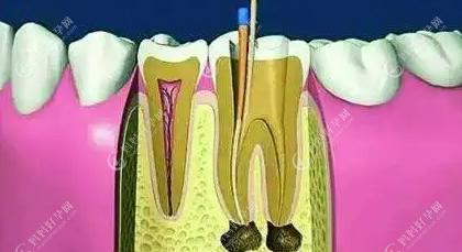牙齿缺损超过牙齿的1/3建议冠修复