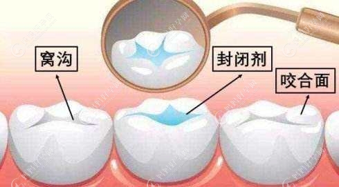 窝沟封闭是在牙齿的哪个地方做的