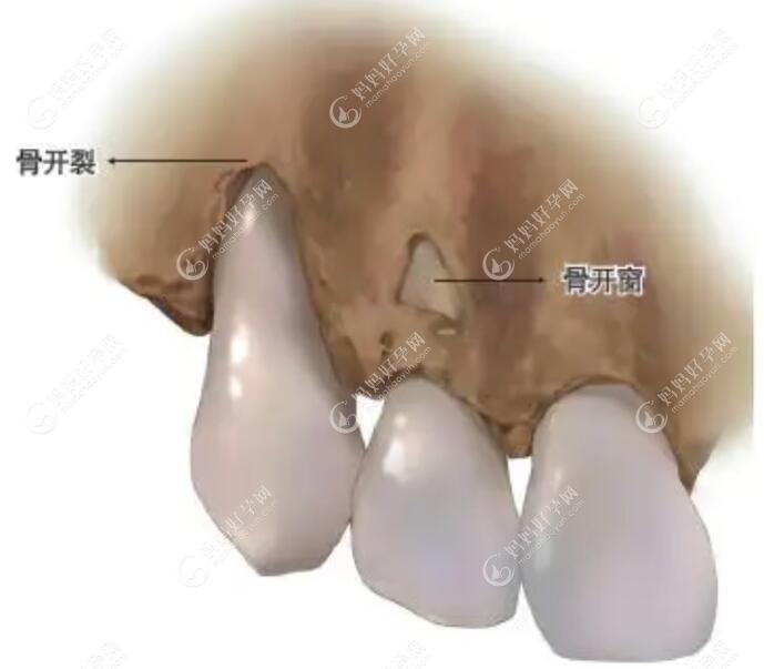 牙槽骨薄适合哪种材质正畸？当然是控根好的隐形牙套啦