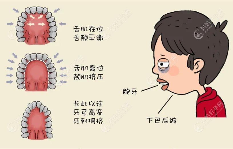 口呼吸影响面部肌肉导致牙列不齐