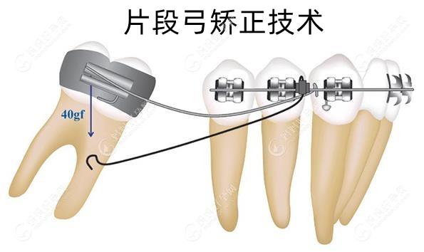 片段弓矫正技术是什么意思?它可对单颗牙齿进行局部正畸哦