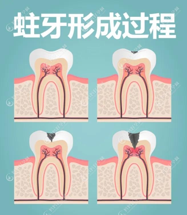儿童龋齿不治疗会影响换牙吗,都说蛀牙换牙后自己就能好？