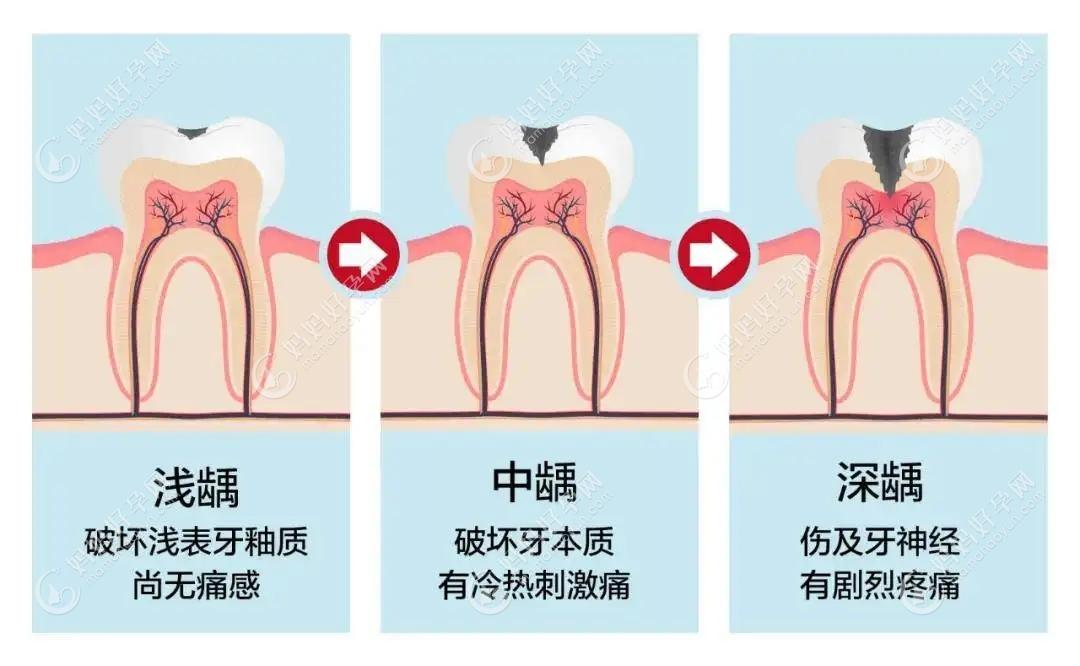 蛀牙的轻重不同症状不同