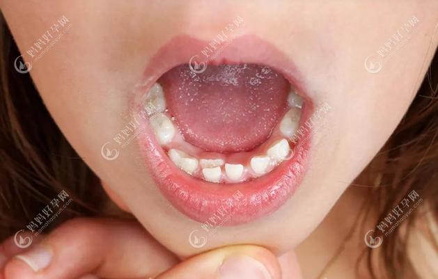 后悔给小孩拔了双排牙，听说小孩双排牙拔了后果严重