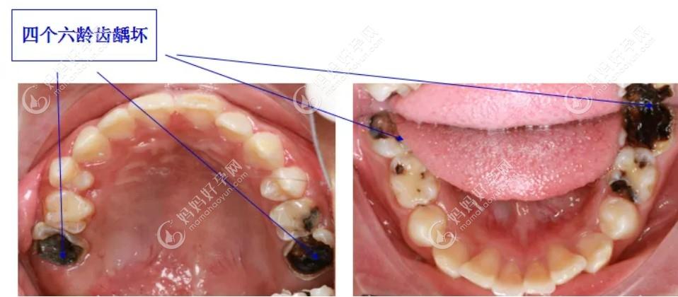 孩子六龄齿坏了该如何补救？补牙、根管治疗都有可能