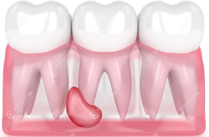 幼儿乳牙牙根囊肿影响发新牙吗，乳牙牙根囊肿会自愈吗？