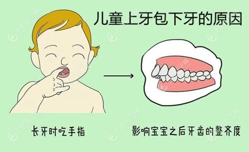 儿童上牙包下牙的原因