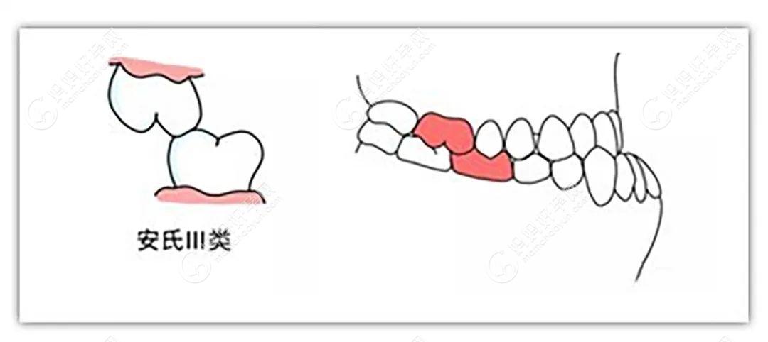 安氏三类牙齿畸形的图片