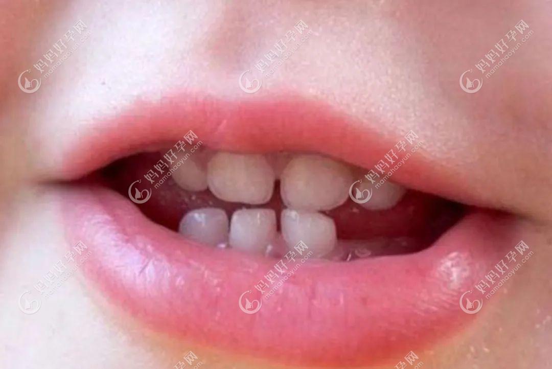 孩子的乳牙有必要保存吗?小孩的乳牙怎么保存才有效能救命