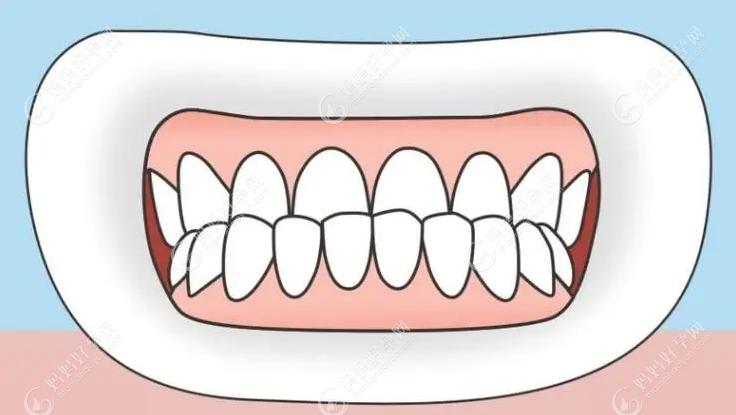 儿童牙齿反颌矫正器哪种比较好?eta,MRC,法克兰3矫正器性价比高
