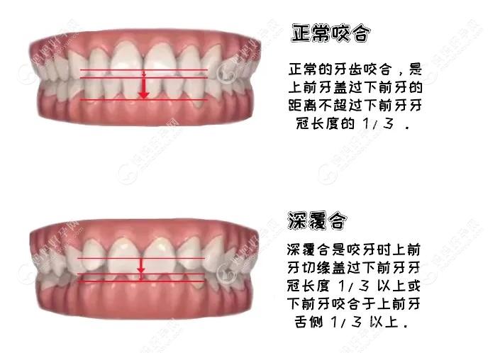 深覆合和正常牙齿的区别图解