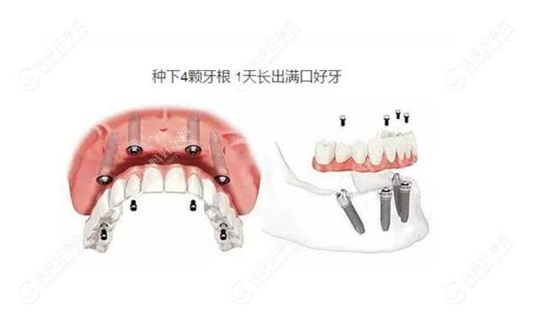 大连唯格口腔门诊部半口即刻种植牙技术