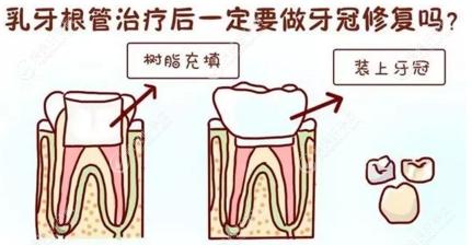 牙医更建议乳牙根管治疗后佩戴牙冠
