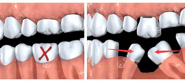 目前三种镶假牙的方式哪种最好?种植牙/烤瓷牙还是活动假牙