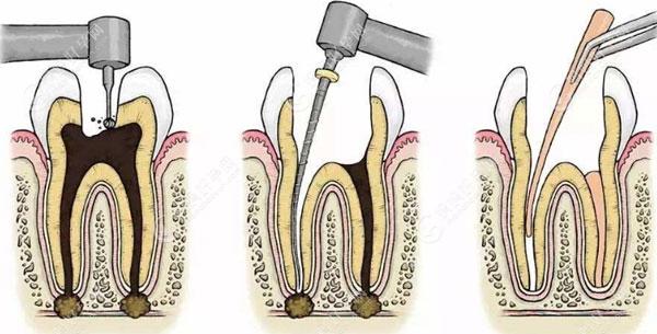 牙齿根管治疗示意图