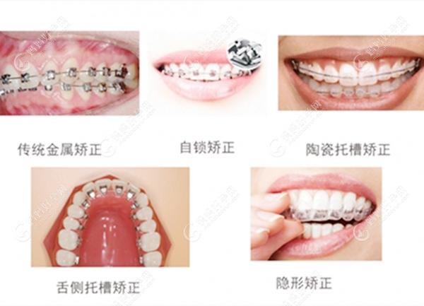 牙齿矫正的各种类型图