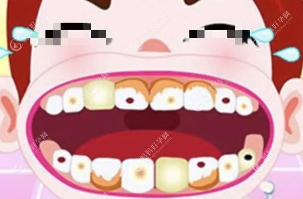 儿童有蛀牙的牙齿状况图