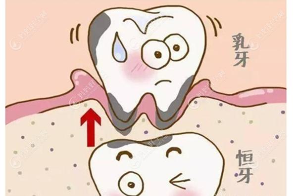 乳牙和恒牙的关系图篇