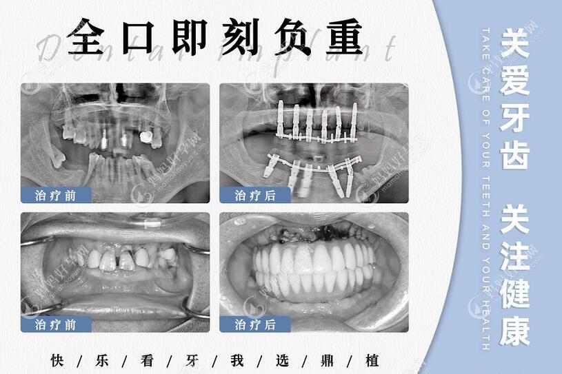种植牙医生高振华的种植牙病例图