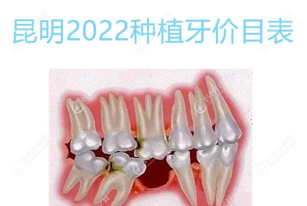 昆明2022种植牙价目表更新,想看单颗/全口种植牙价格这都有