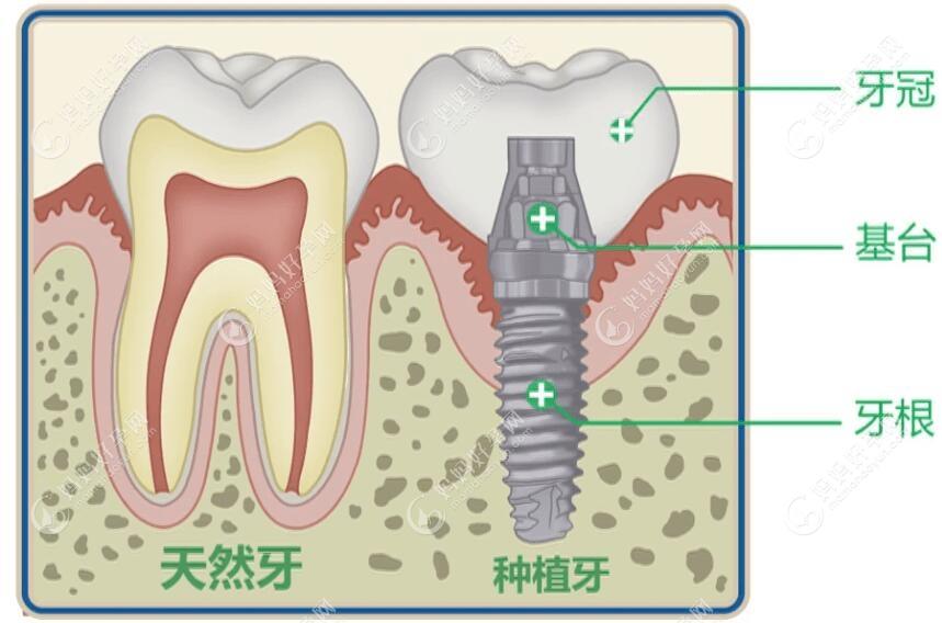 种植牙与天然牙结构对比