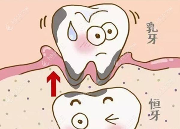 儿童乳牙和恒牙的关系图